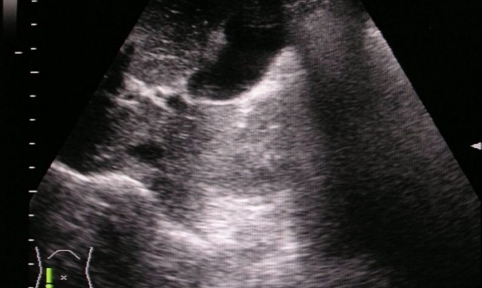 sono, ultrazvuk, apendix, zobrazení