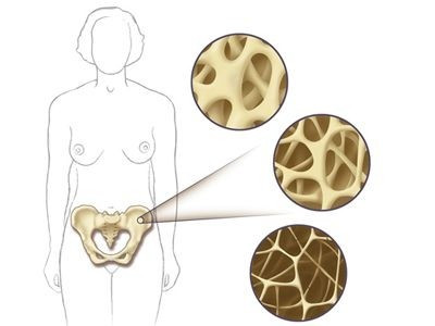 Osteoporóza, kosti, kostní tkáň