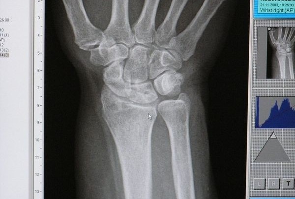 www osteoporóza cz infecția articulației genunchiului