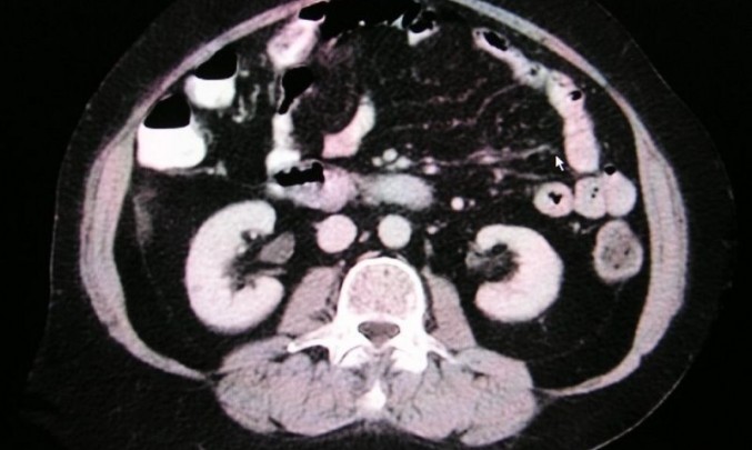 CT ledvin