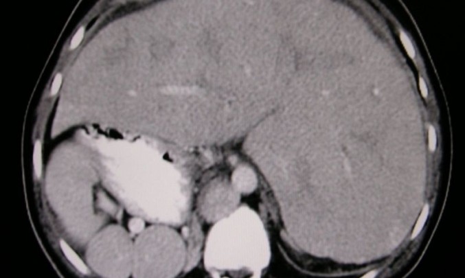 situs viscerum inversus