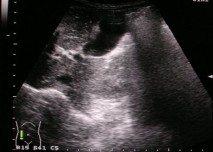 sono, ultrazvuk, apendix, zobrazení
