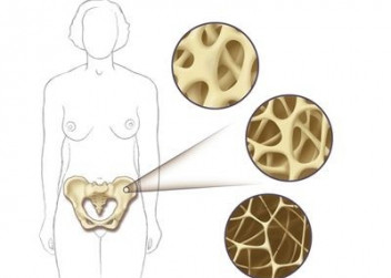 Osteoporóza, kosti, kostní tkáň