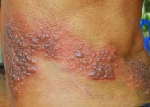 Virus herpes simplex typu 2